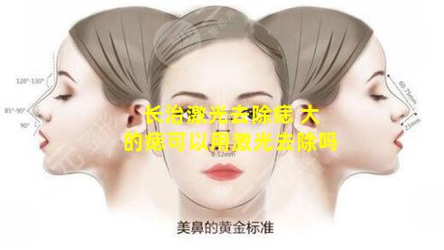 长治激光去除痣 大的痣可以用激光去除吗